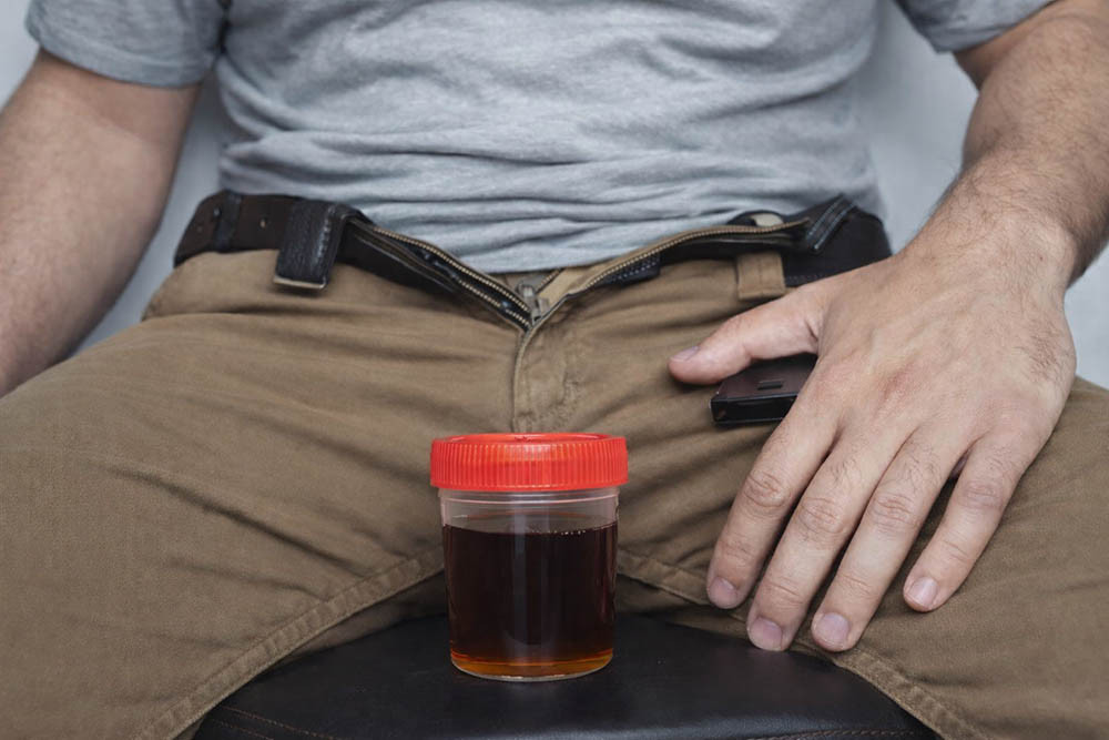 Почему моча темнеет после запоя